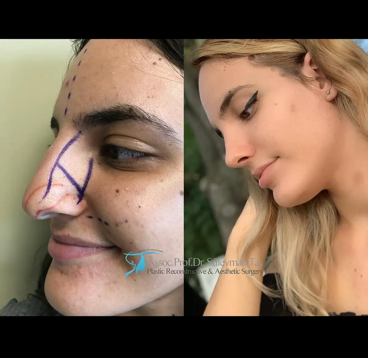 Suleyman Tas reviews – verified rhinoplasty patient review #163 (photo 2)