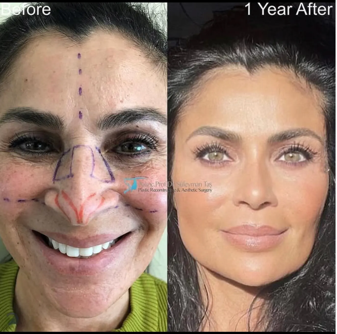 Suleyman Tas reviews – verified rhinoplasty patient review #54