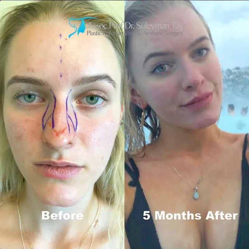 Suleyman Tas reviews – verified rhinoplasty patient review #189 (photo 2)