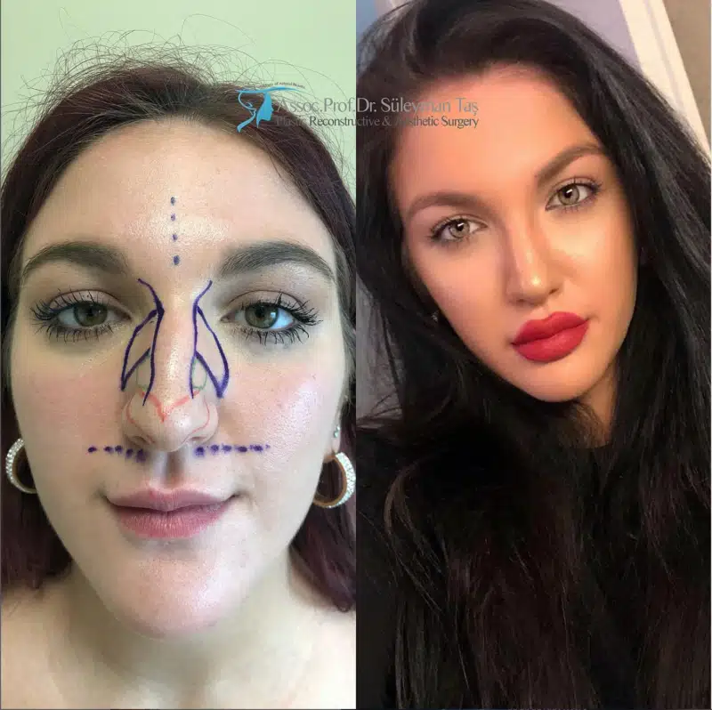 Suleyman Tas reviews – verified rhinoplasty patient review #173 (photo 2)