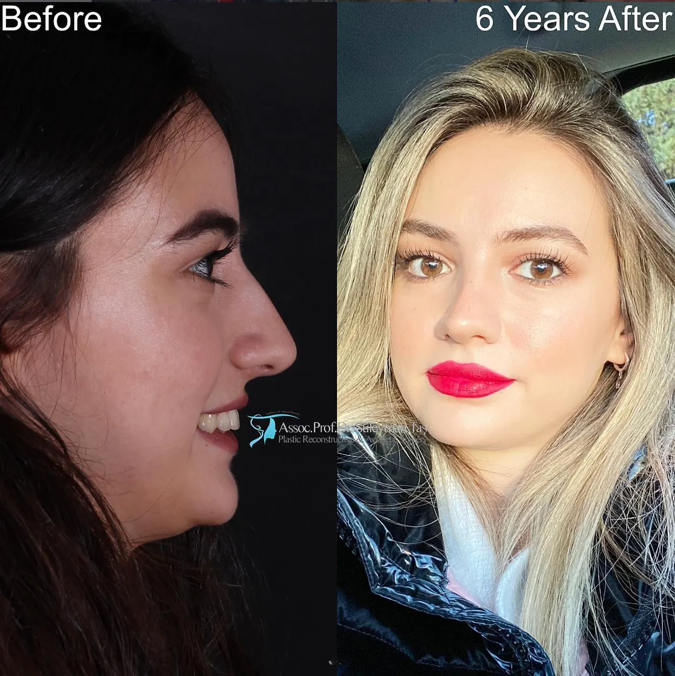Suleyman Tas reviews – verified rhinoplasty patient review #78 (photo 2)