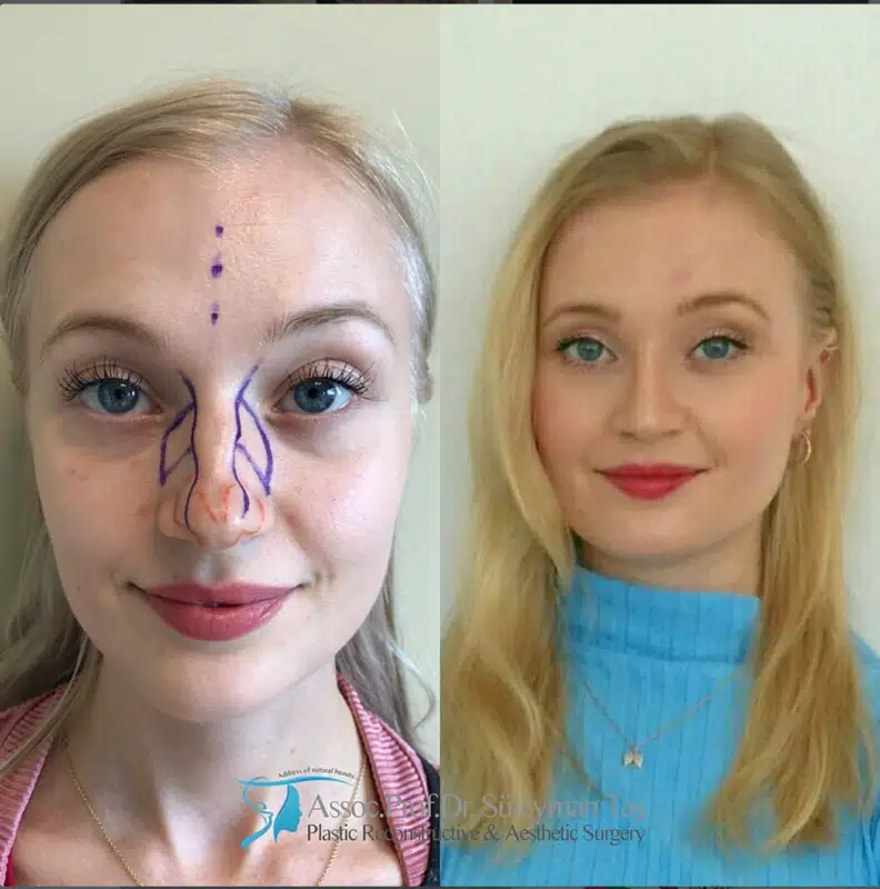 Suleyman Tas reviews – verified rhinoplasty patient review #180 (photo 2)