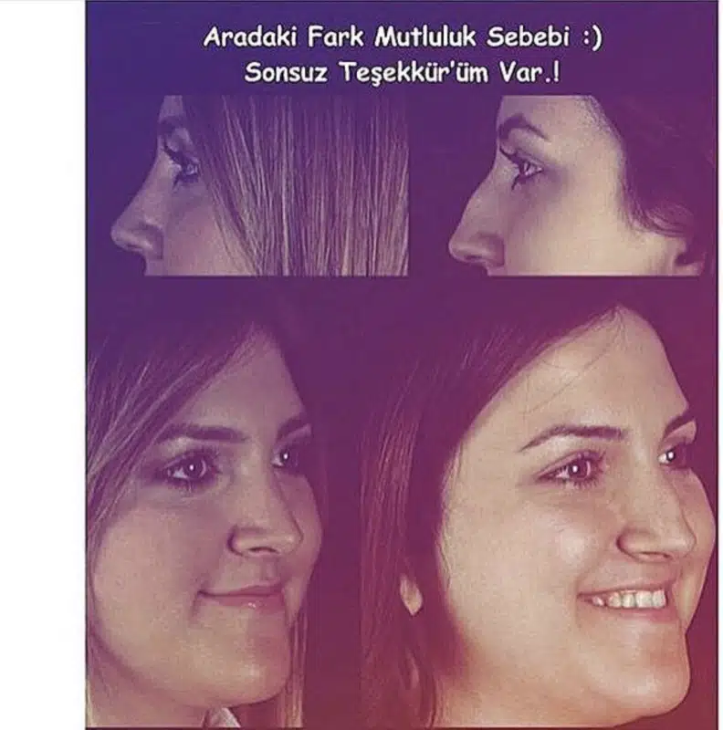 Suleyman Tas reviews – verified rhinoplasty patient review #285