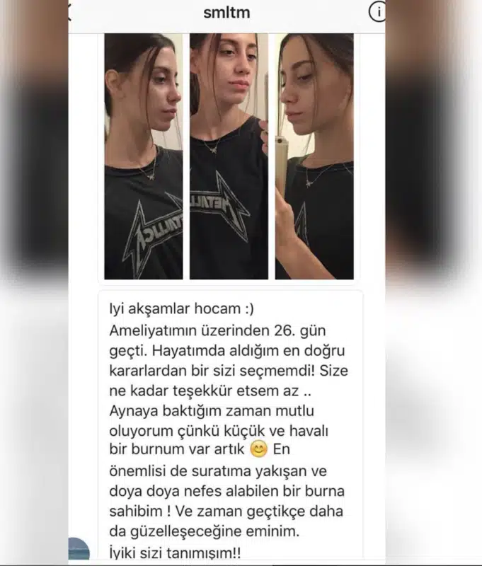 Suleyman Tas reviews – verified rhinoplasty patient review #290