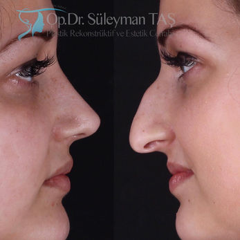 Revision Rhinoplasty before and after photo of a female patient, side profile view, by Prof. Dr. Süleyman Taş, plastic surgeon in Istanbul
