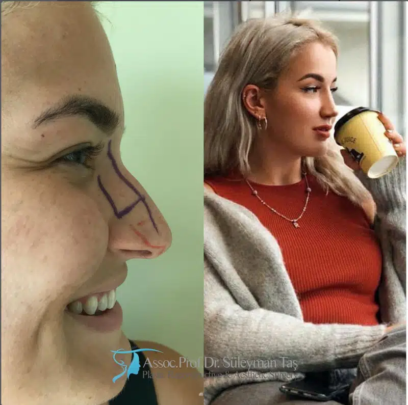Suleyman Tas reviews – verified rhinoplasty patient review #182 (photo 2)