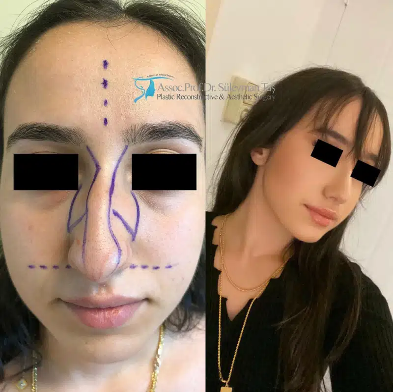 Suleyman Tas reviews – verified rhinoplasty patient review #162 (photo 1)