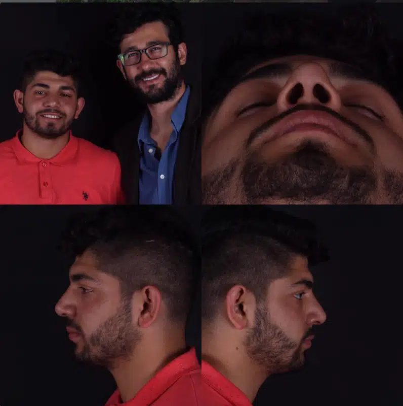 Suleyman Tas reviews – verified rhinoplasty patient review #312