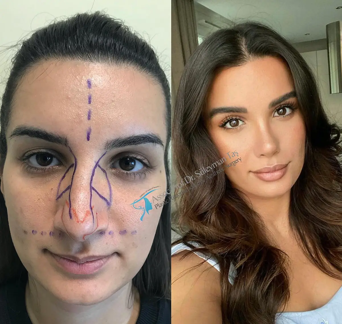 Suleyman Tas reviews – verified rhinoplasty patient review #158