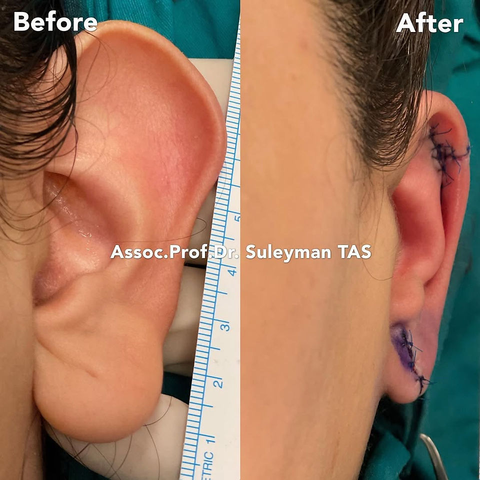 Otoplasty (ear pinning) before and after, case 30, side view, patient of Prof. Dr. Suleyman Tas, plastic surgeon in Istanbul