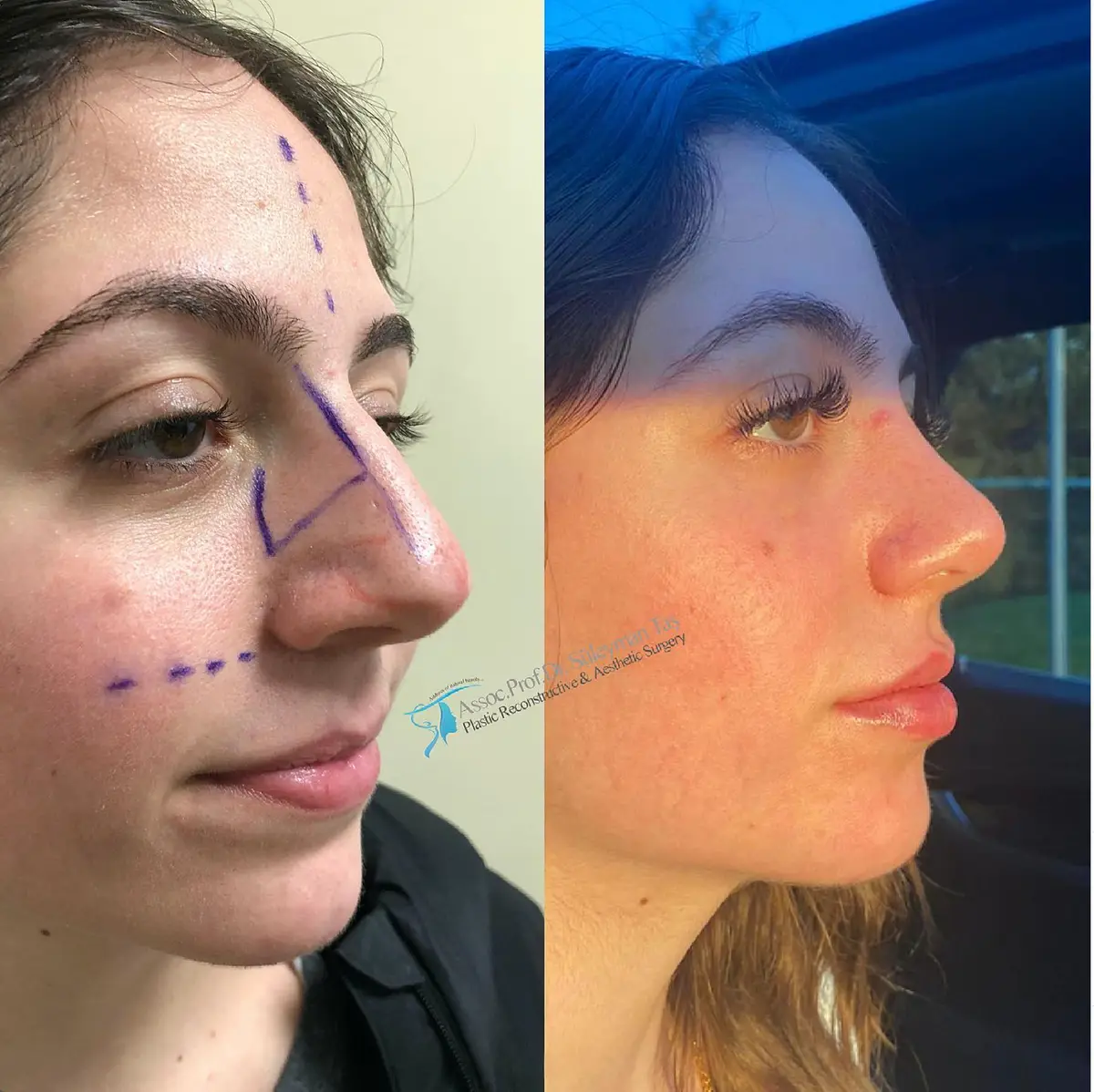 Suleyman Tas reviews – verified rhinoplasty patient review #133 (photo 1)