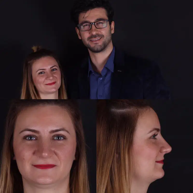 Suleyman Tas reviews – verified rhinoplasty patient review #244