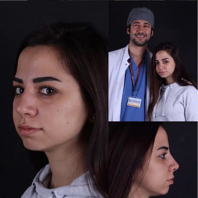 Suleyman Tas reviews – verified rhinoplasty patient review #366
