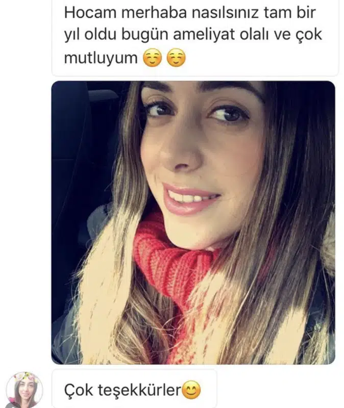 Suleyman Tas reviews – verified rhinoplasty patient review #250