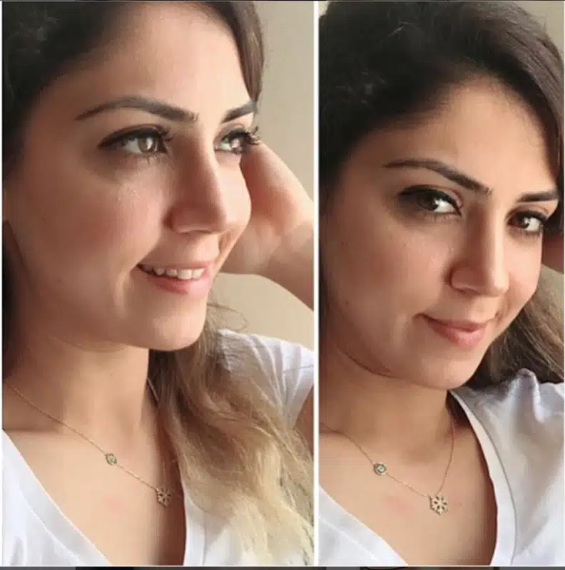 Suleyman Tas reviews – verified rhinoplasty patient review #232 (photo 1)
