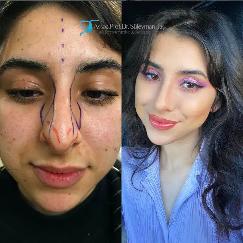 Suleyman Tas reviews – verified rhinoplasty patient review #177 (photo 2)