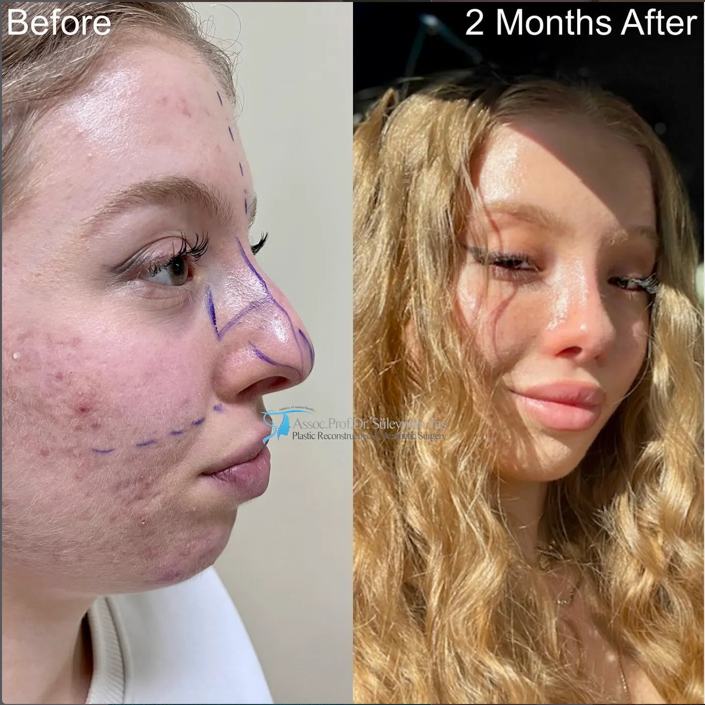 Suleyman Tas reviews – verified rhinoplasty patient review #62 (photo 2)