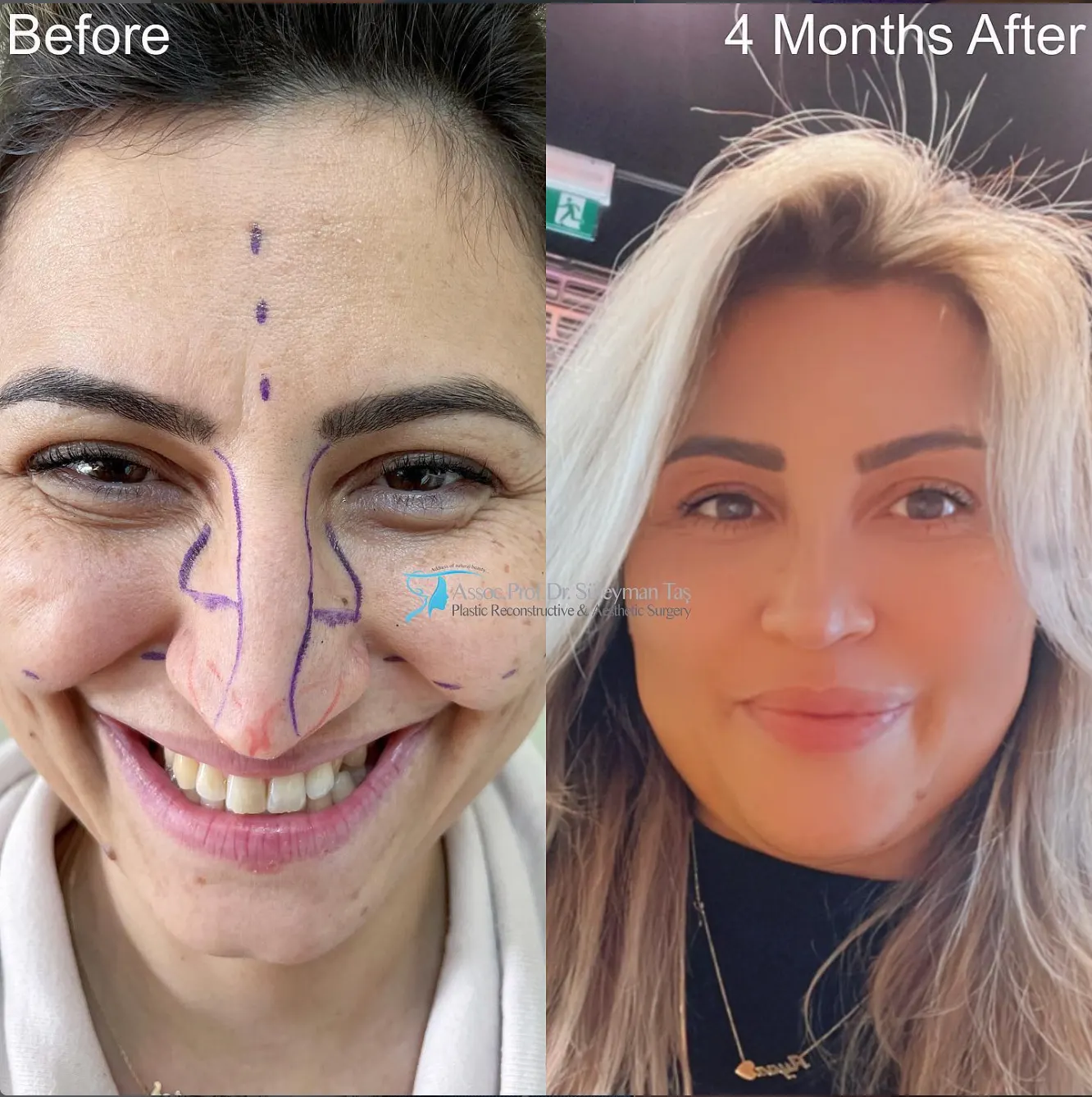 Suleyman Tas reviews – verified rhinoplasty patient review #65 (photo 2)