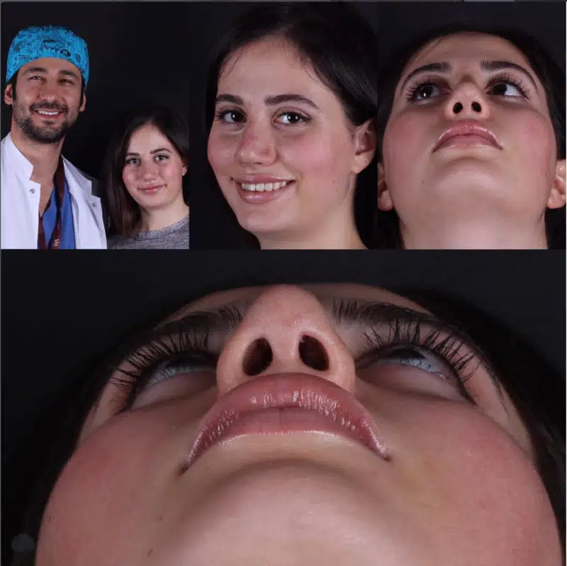 Suleyman Tas reviews – verified rhinoplasty patient review #347