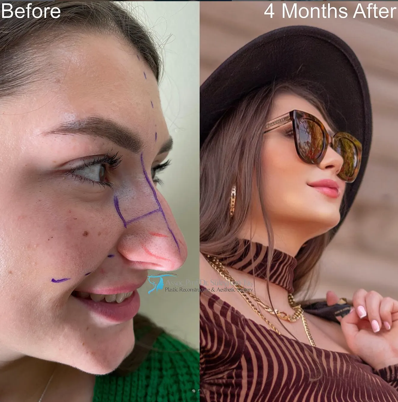 Suleyman Tas reviews – verified rhinoplasty patient review #81 (photo 2)