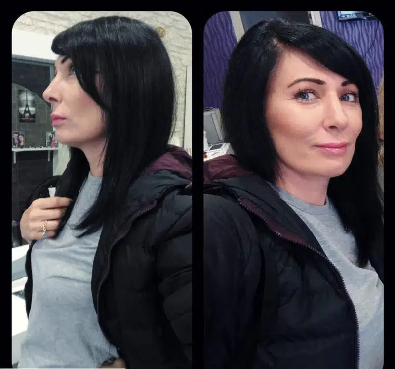 Suleyman Tas reviews – verified rhinoplasty patient review #379