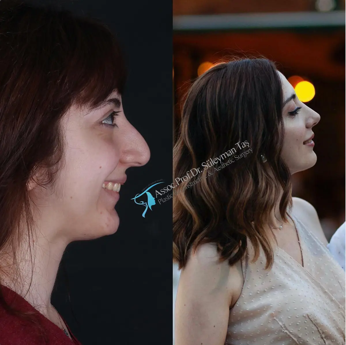 Suleyman Tas reviews – verified rhinoplasty patient review #168 (photo 1)
