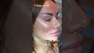 Scarless facelift and neck lift, before and after, patient of Prof. Dr. Suleyman Tas Clinic, Istanbul