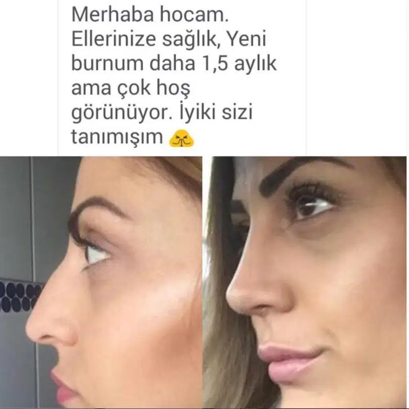 Suleyman Tas reviews – verified rhinoplasty patient review #269
