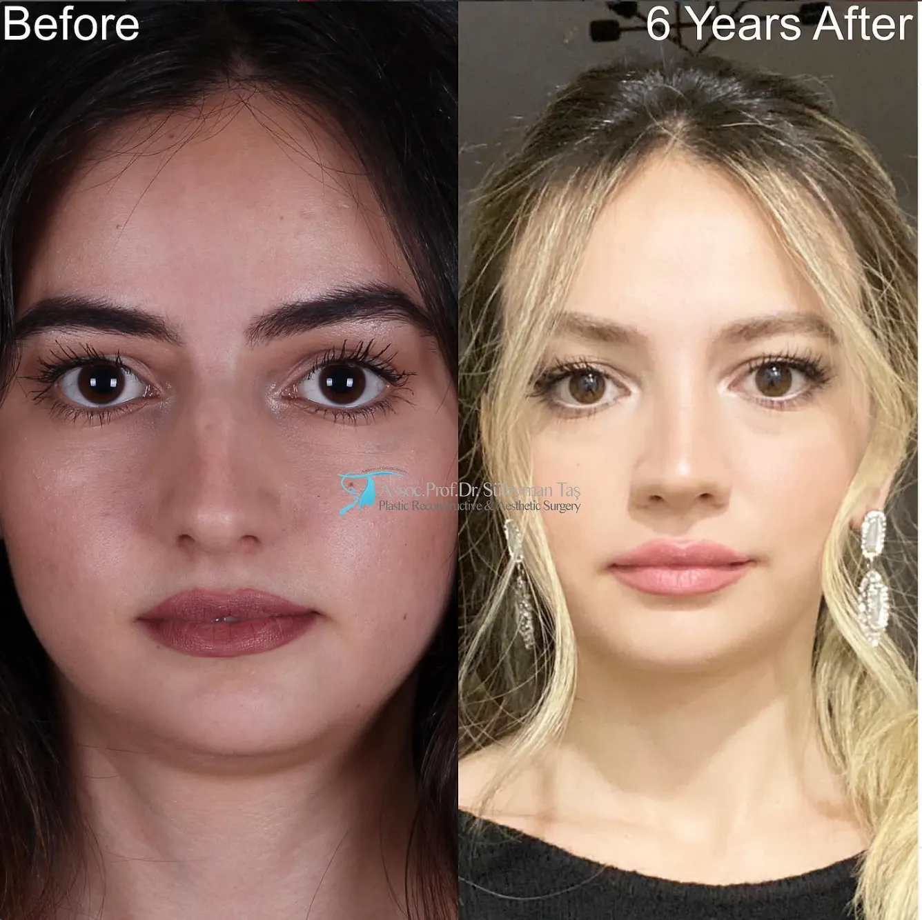 Suleyman Tas reviews – verified rhinoplasty patient review #78 (photo 1)