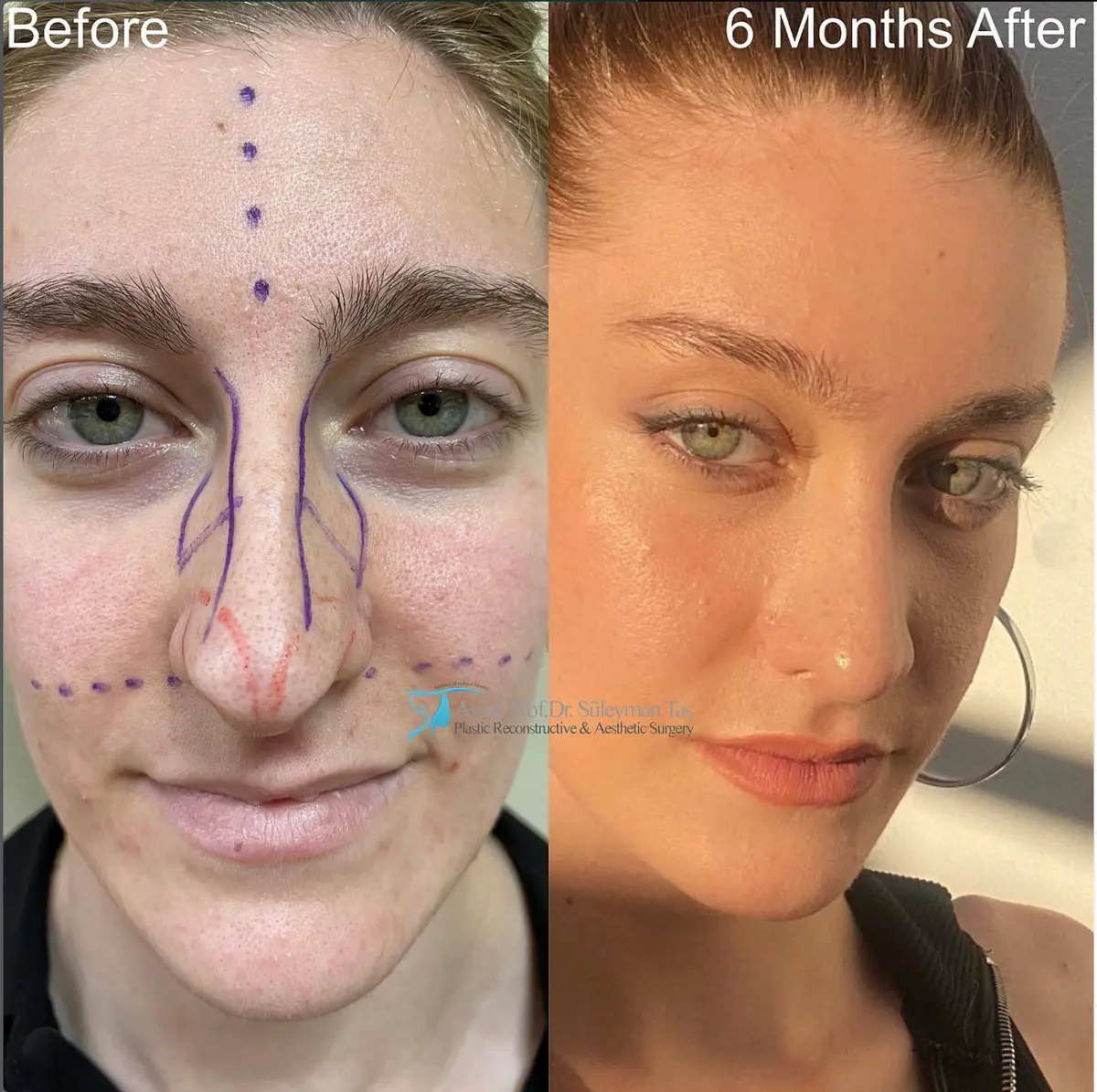 Suleyman Tas reviews – verified rhinoplasty patient review #95 (photo 1)