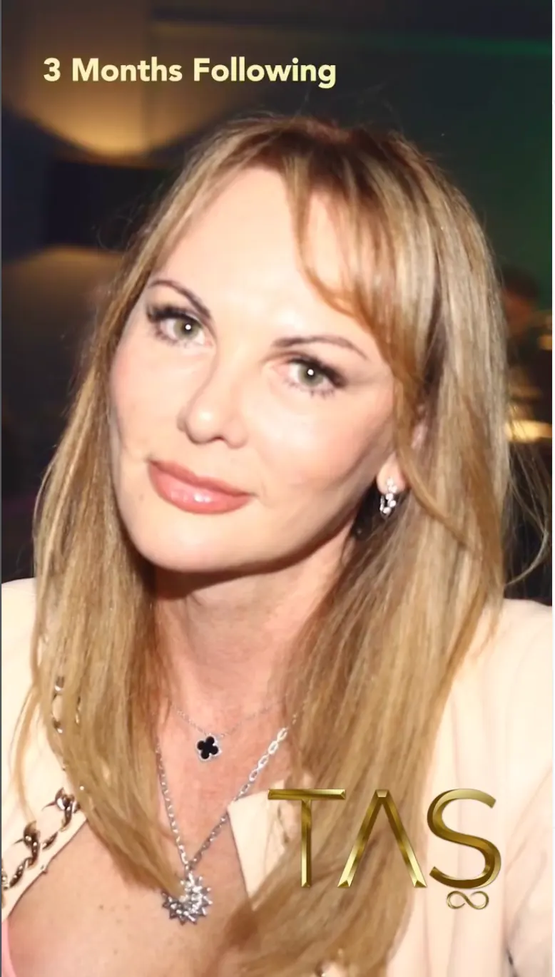 Suleyman Tas reviews – verified facelift patient review #15