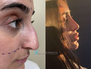 Closed Rhinoplasty before and after photo of a female patient, side profile view, 7 months after surgery, by Prof. Dr. Süleyman Taş, plastic surgeon in Istanbul