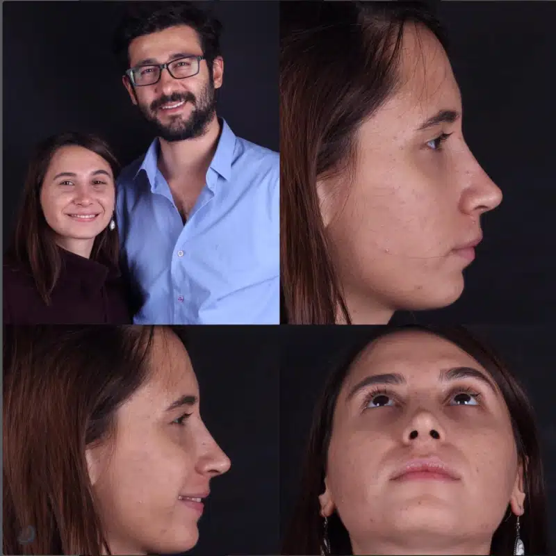 Suleyman Tas reviews – verified rhinoplasty patient review #271
