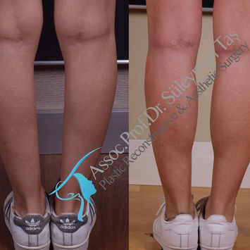 Leg Contouring before and after photo of a female patient, front view, by Prof. Dr. Süleyman Taş, plastic surgeon in Istanbul