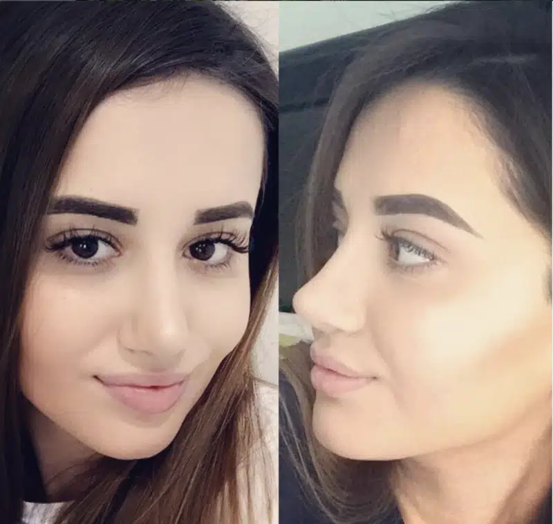 Suleyman Tas reviews – verified rhinoplasty patient review #230