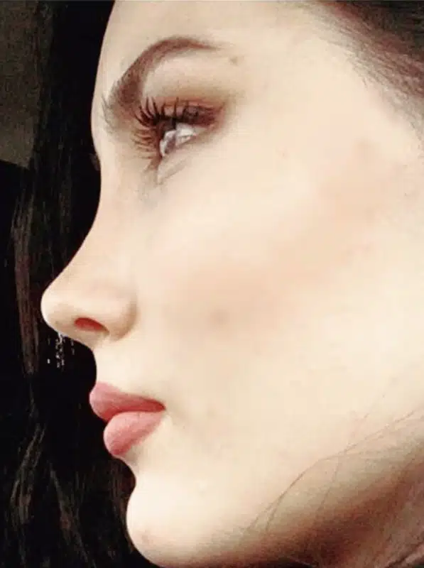 Suleyman Tas reviews – verified rhinoplasty patient review #240