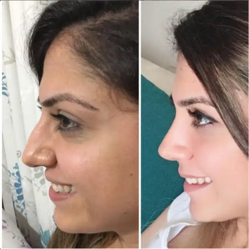 Suleyman Tas reviews – verified rhinoplasty patient review #232 (photo 3)