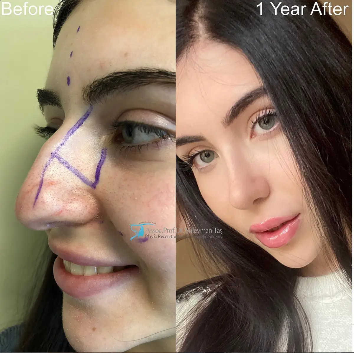 Suleyman Tas reviews – verified rhinoplasty patient review #100