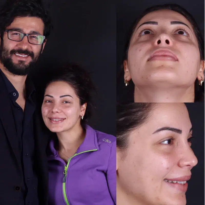 Suleyman Tas reviews – verified rhinoplasty patient review #268