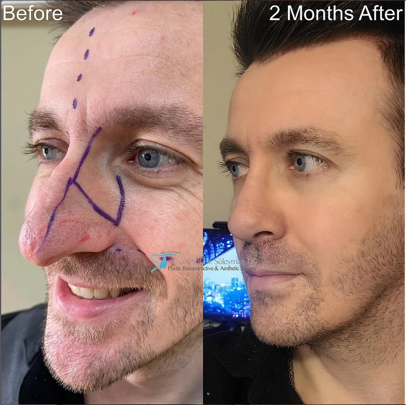 Suleyman Tas reviews – verified rhinoplasty patient review #90 (photo 3)