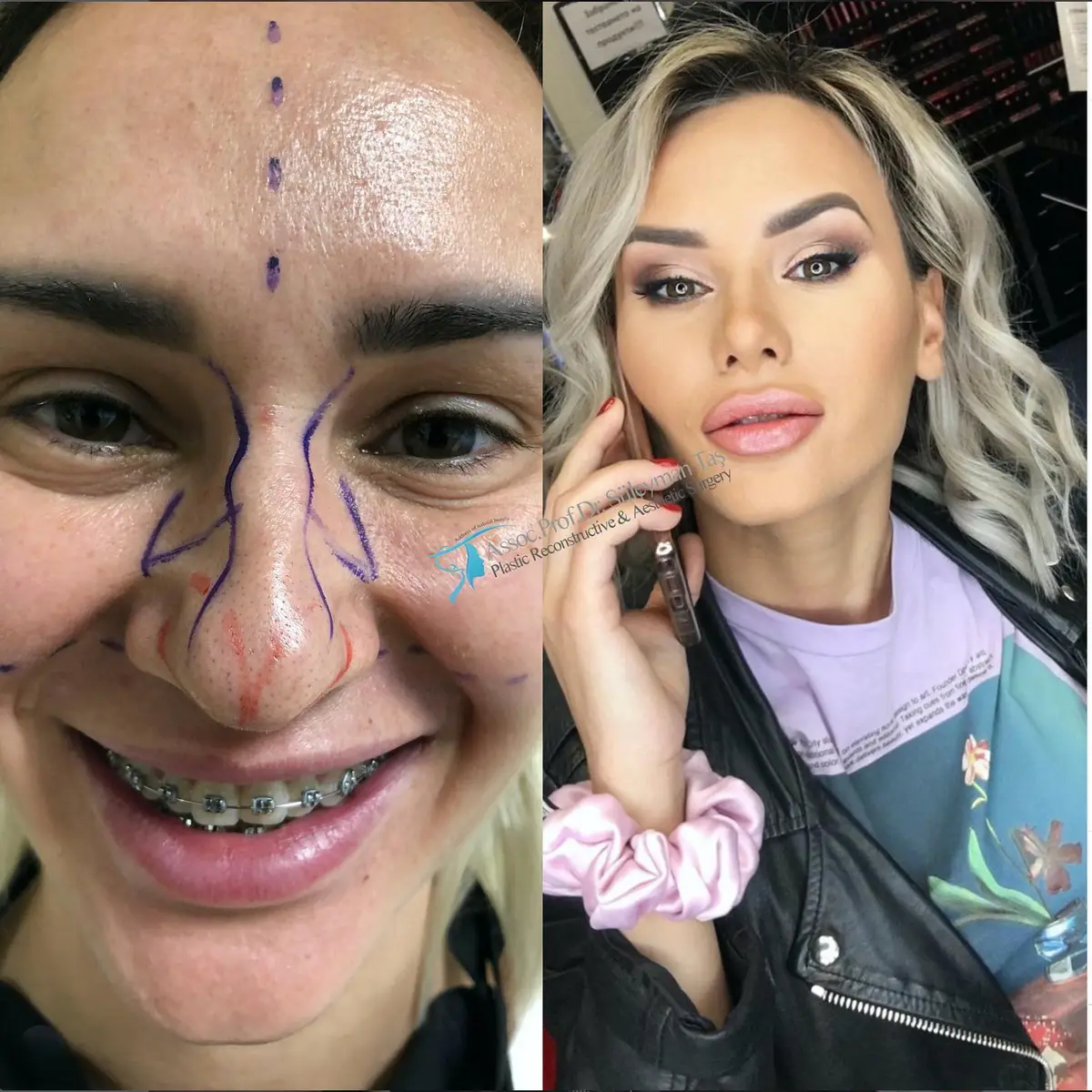 Suleyman Tas reviews – verified rhinoplasty patient review #139 (photo 2)