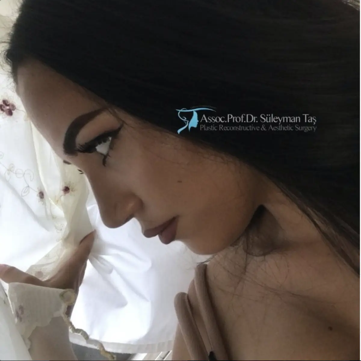 Suleyman Tas reviews – verified rhinoplasty patient review #121