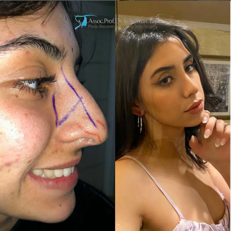 Suleyman Tas reviews – verified rhinoplasty patient review #177 (photo 1)