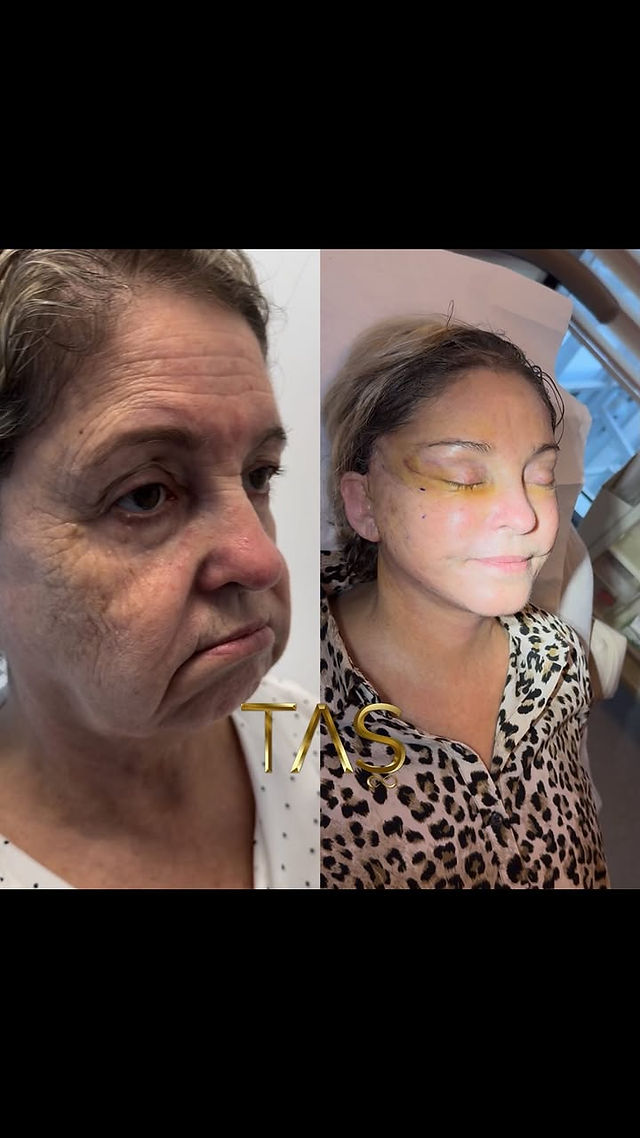 Deep plane facelift before and after, case 13, three-quarter view, patient of Prof. Dr. Suleyman Tas, plastic surgeon in Istanbul