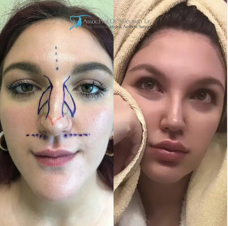 Suleyman Tas reviews – verified rhinoplasty patient review #173 (photo 1)