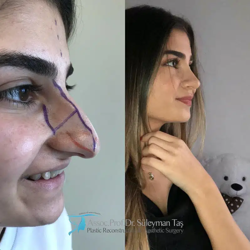 Suleyman Tas reviews – verified rhinoplasty patient review #186 (photo 1)