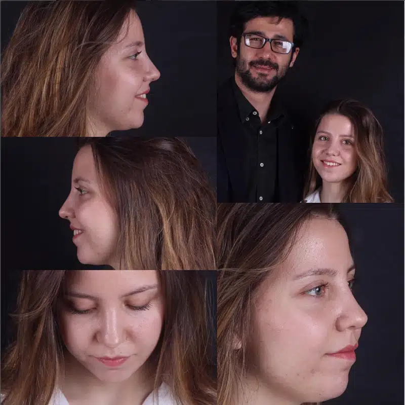 Suleyman Tas reviews – verified rhinoplasty patient review #328