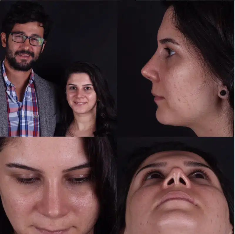 Suleyman Tas reviews – verified rhinoplasty patient review #284
