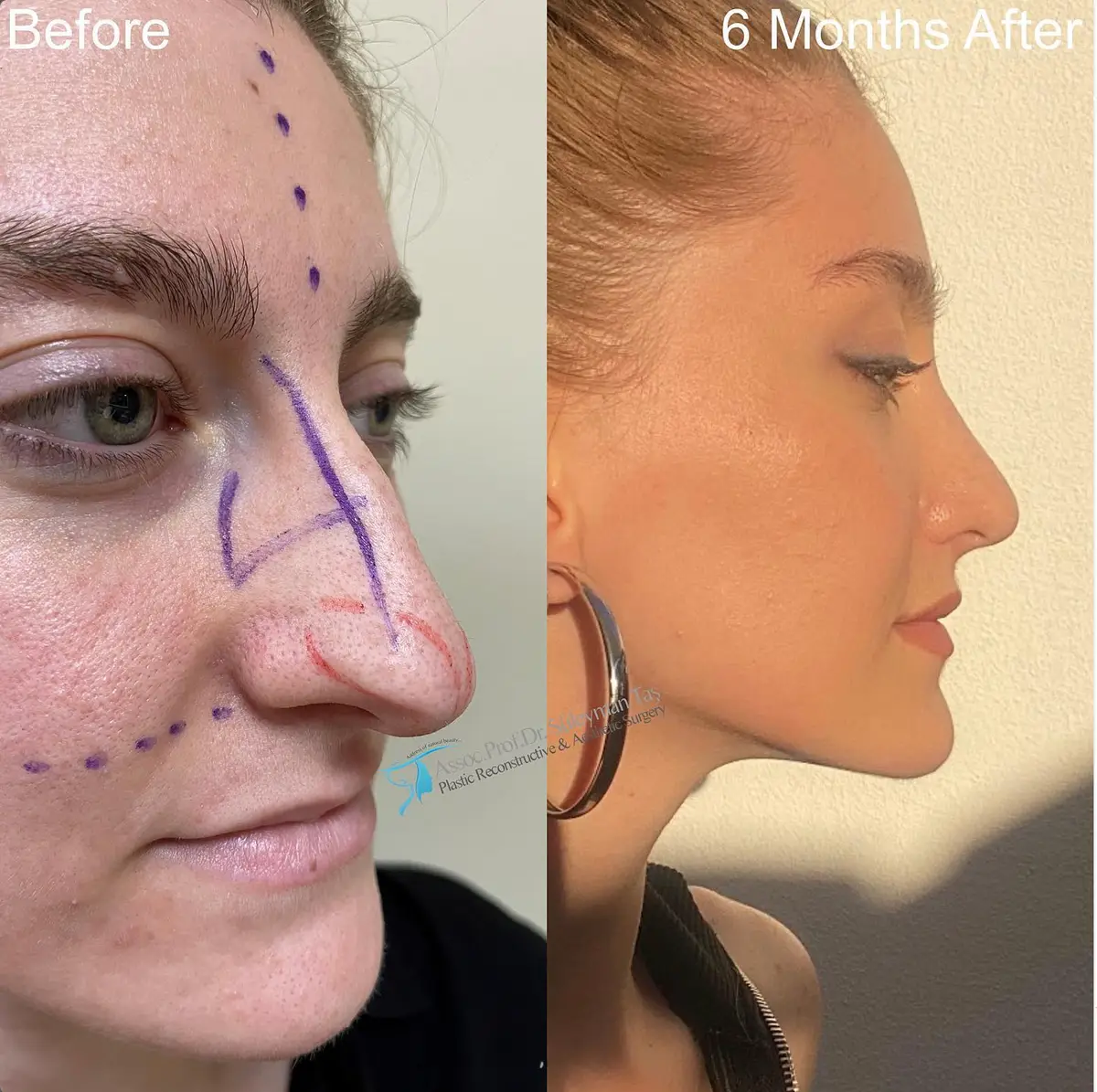 Suleyman Tas reviews – verified rhinoplasty patient review #95 (photo 2)