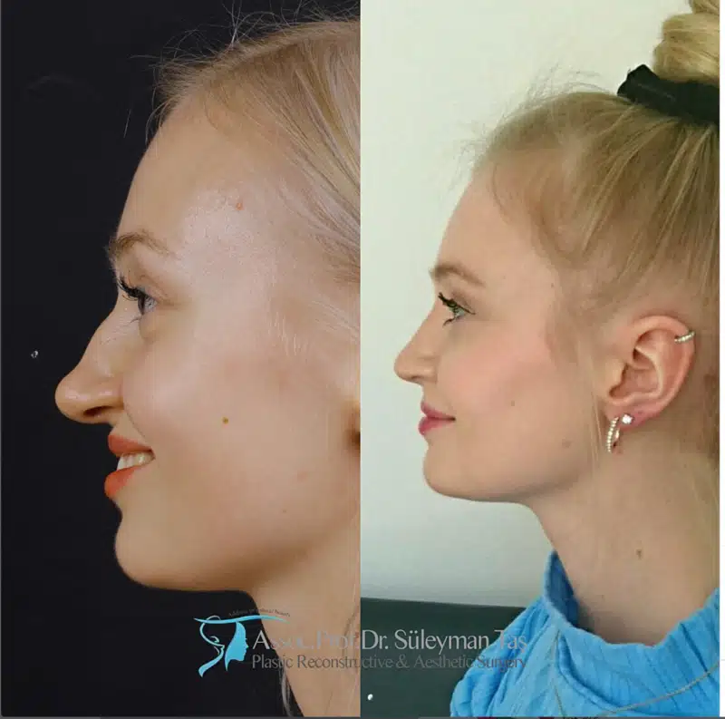 Suleyman Tas reviews – verified rhinoplasty patient review #180 (photo 3)